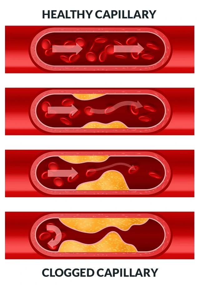 Diagram comparing a healthy capillary with clear blood flow to a clogged capillary with restricted blood flow
