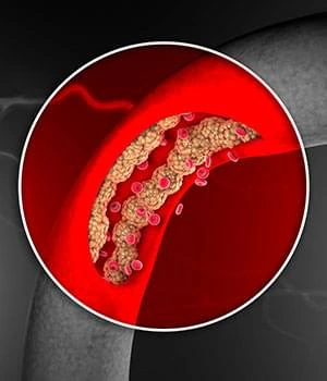 Close-up illustration of restricted blood flow through a narrowed blood vessel